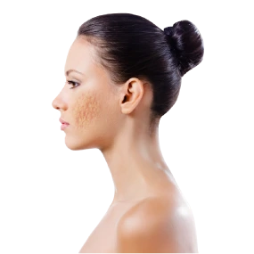 Acne Scar Treatment