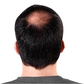 Hair Loss