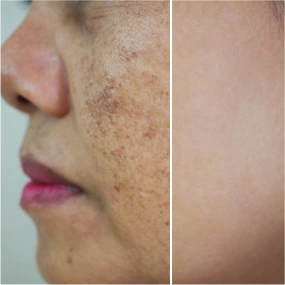 Wrinkle Reduction