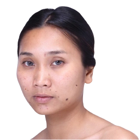 Wrinkle Reduction