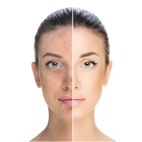 Pigmentation Treatment