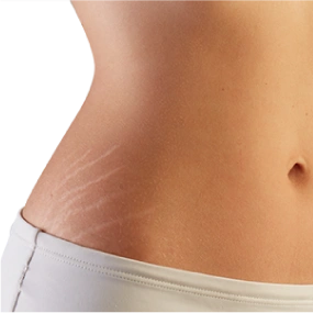 Stretch Marks